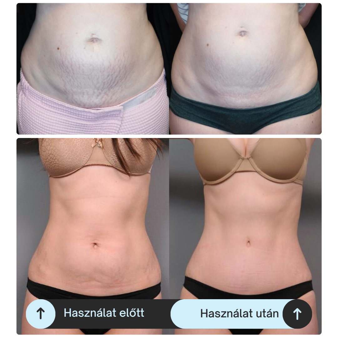 Has terület illusztráció fényterápiás szalaggal kezelve; bőrhibák javítása és zsírbontás támogatása (példa képek).